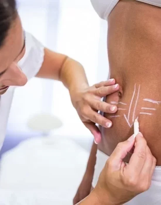surgeon-drawing-lines-womans-abdomen-liposuction-cellulite-removal surgeon-drawing-lines-womans-abdomen-liposuction-cellulite-removal